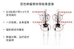 上饒市人民醫(yī)院核醫(yī)學科骨檢查與治療